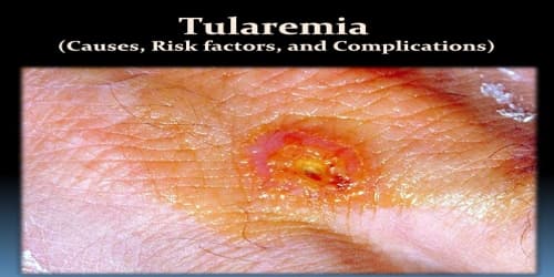 Tularemia (Causes, Risk factors, and Complications)
