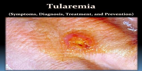 Tularemia (Symptoms, Diagnosis, Treatment, and Prevention)