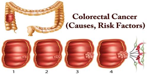 Colorectal Cancer (Causes, Risk Factors)