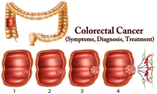 Colorectal Cancer (Symptoms, Diagnosis, Treatment)