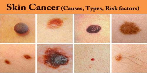 Skin Cancer (Causes, Types, Risk factors)