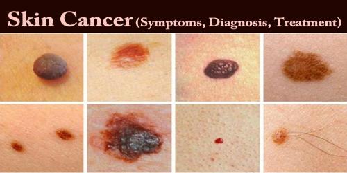 Skin Cancer (Symptoms, Diagnosis, Treatment)