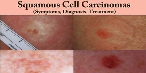 Squamous Cell Carcinomas (Symptoms, Diagnosis, Treatment)