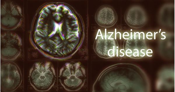 Researchers Suggest a New Treatment Target for Alzheimer’s Disease