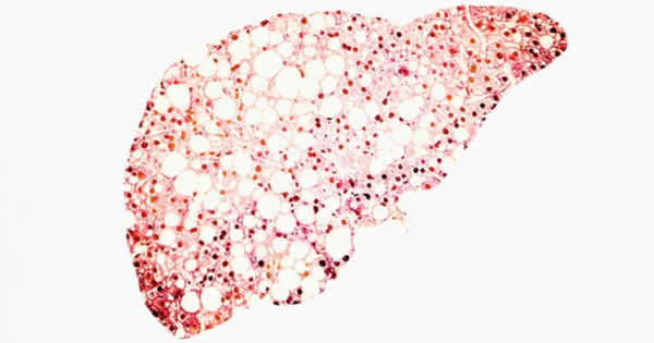 Getting to the Bottom of the Threat of Non-alcoholic Liver Disease