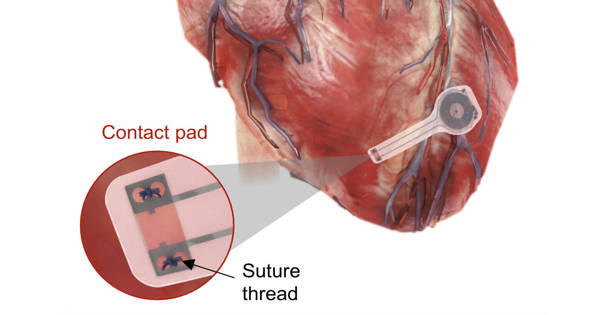 The Transient Pacemaker Disintegrates Harmlessly in the Body