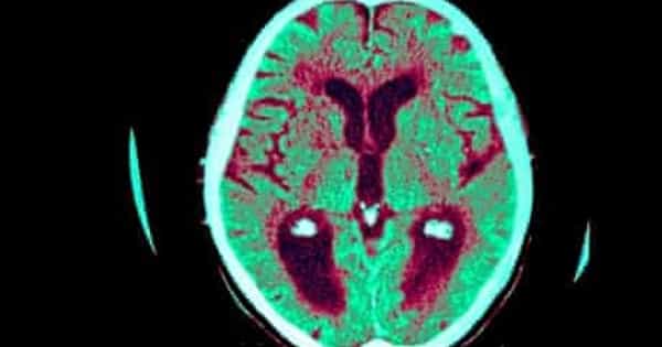 Dementia Signs are Recorded in the Blood