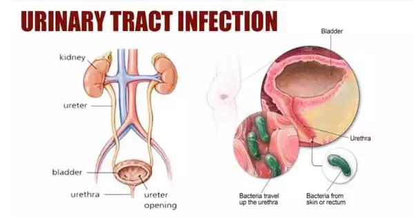 Urinary Tract Infections – Everything You Should Know - Assignment Point