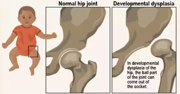 Infancy Hip Dysplasia can be Predicted Using Ultrasound