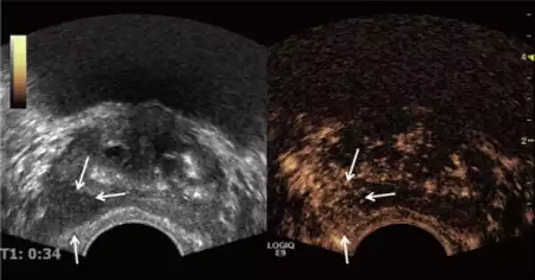 Prostate Cancer can be Detected using Ultrasound Scan