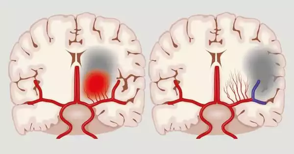 Migraine with Aura and Blood Clot Factors Could be Related