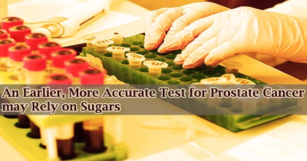 An Earlier, More Accurate Test for Prostate Cancer May Rely on Sugars