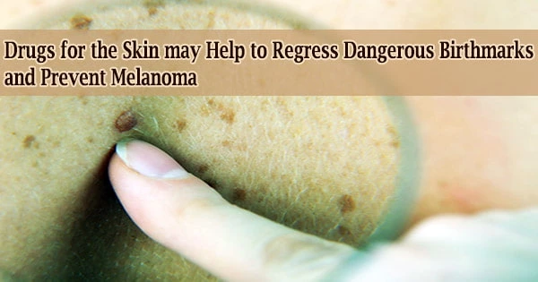 Drugs for the Skin may Help to Regress Dangerous Birthmarks and Prevent Melanoma
