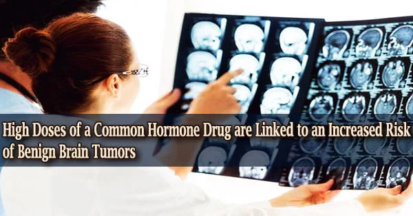High Doses of a Common Hormone Drug are Linked to an Increased Risk of Benign Brain Tumors