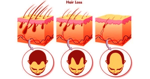 Strong Signaling Molecule Stimulates the Growth of New Hair