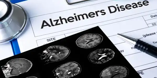 Alzheimers-Sufferers-are-Drowsy-due-to-Neuron-Loss-not-a-Lack-of-Sleep-1