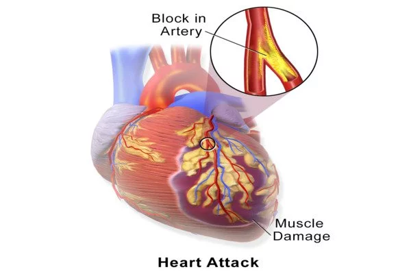 Artificial-Intelligence-enhances-Care-for-Heart-Attack-Victims-in-Women-1