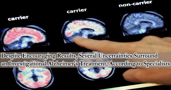 Despite Encouraging Results, Several Uncertainties Surround an Investigational Alzheimer’s Treatment, According to Specialists