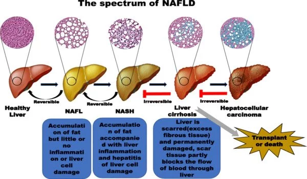 The-Progression-of-Nonalcoholic-Fatty-Liver-Disease-1