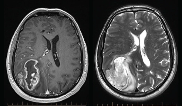 Increasing-the-Vulnerability-of-Glioblastoma-to-Treatment-1