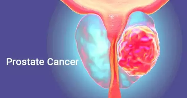 New Prostate Cancer Epigenetic Markers Discovered