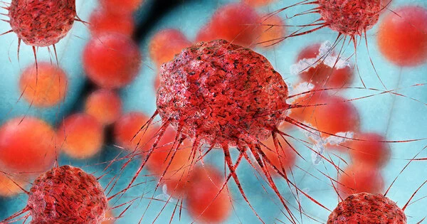 The Cause of Prostate Cancer Metastasis has been Identified