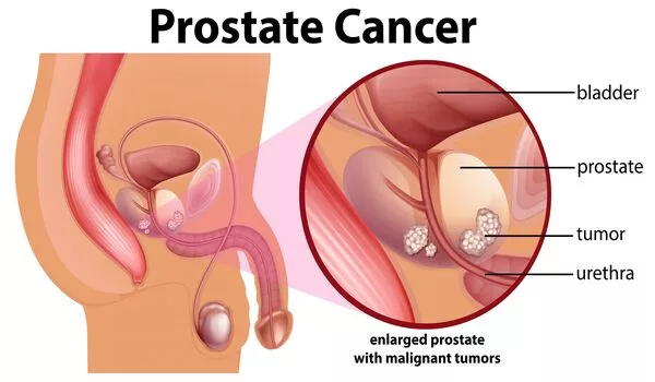 What-causes-Prostate-Cancer-1