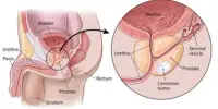 What causes Prostate Cancer?