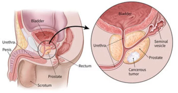 What causes Prostate Cancer?