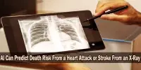 AI Can Predict Death Risk From a Heart Attack or Stroke From an X-Ray