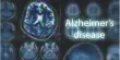 Discovered a New Target for Alzheimer’s Treatments