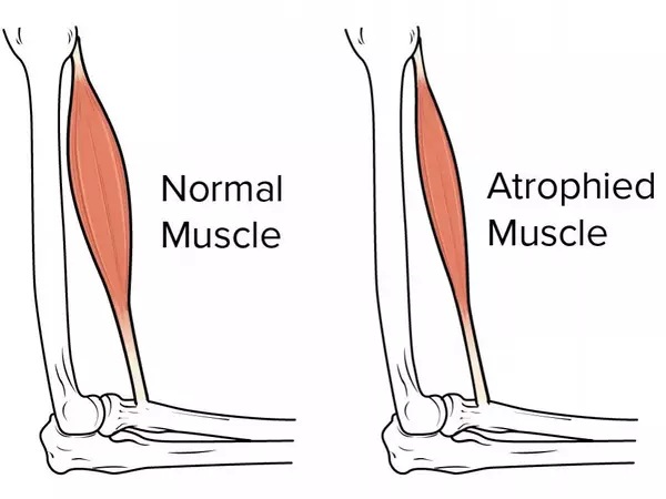 Muscles-that-had-been-Wasted-were-Rebuilt-more-Effectively-1