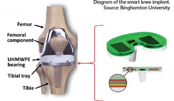 Patient-specific-Knee-Implants-can-be-Solved-Using-Generative-Design-1