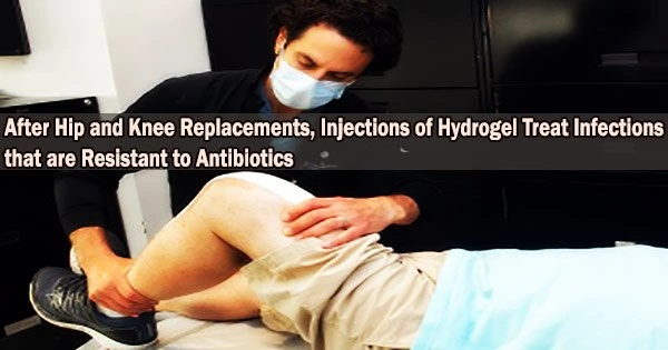 After Hip and Knee Replacements, Injections of Hydrogel Treat Infections that are Resistant to Antibiotics