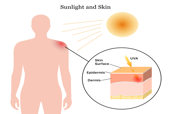 Photosensitivity