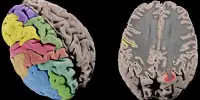 Why the Gyri in the Human Cerebral Cortex Fold Excessively
