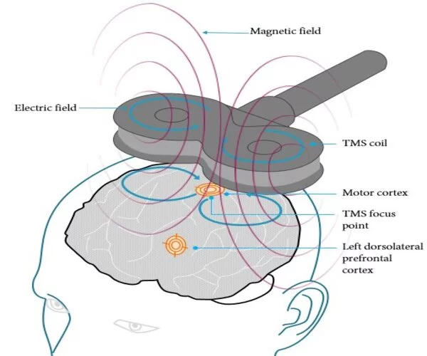 Transcranial magnetic stimulation design goes deeper into brain