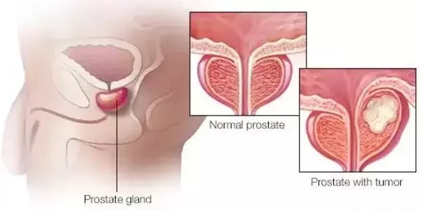 Researchers identify drug resistance factors for advanced prostate cancer