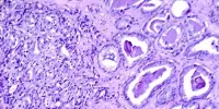 Drug Resistance Factors in Advanced Prostate Cancer have been identified