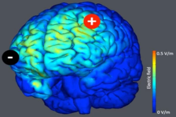 Electrical Brain Stimulation