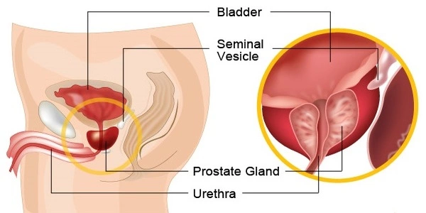 How prostate cancer may begin