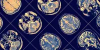 Obesity-related Neurodegeneration is found to mimic Alzheimer’s disease