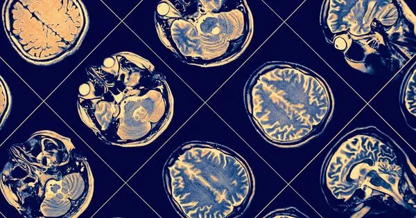 Obesity-related Neurodegeneration is found to mimic Alzheimer’s disease