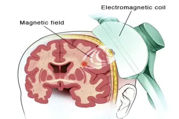 Transcranial Magnetic Stimulation