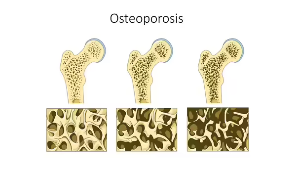 Air pollution speeds bone loss from osteoporosis