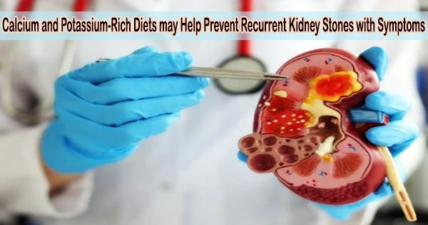 Calcium and Potassium-Rich Diets may Help Prevent Recurrent Kidney Stones with Symptoms