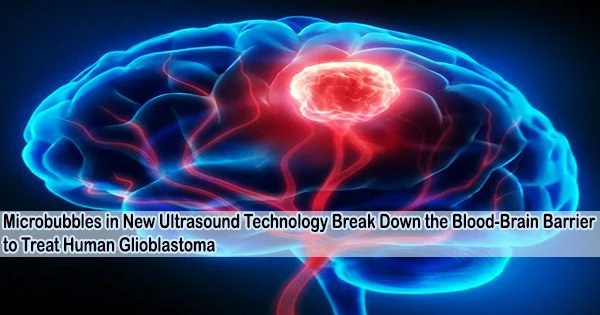 Microbubbles in New Ultrasound Technology Break Down the Blood-Brain Barrier to Treat Human Glioblastoma