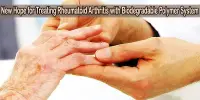 New Hope for Treating Rheumatoid Arthritis with Biodegradable Polymer System
