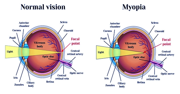 Taking-a-long-term-Approach-to-Myopia-Management