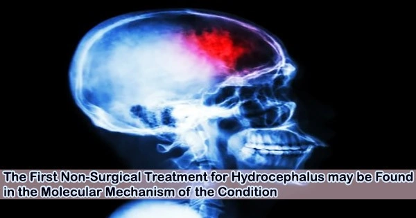 The First Non-Surgical Treatment for Hydrocephalus may be Found in the Molecular Mechanism of the Condition
